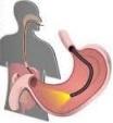 Brochure Informativa Endoscopia Digestiva